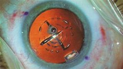 Intervento Cataratta