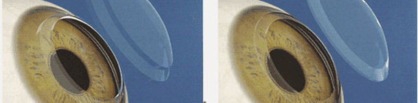 trapianto della cornea