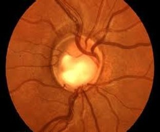 Glaucoma Angolo chiuso