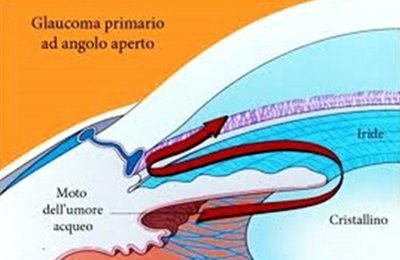 forme di glaucoma