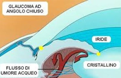 Glaucoma ad angolo chiuso