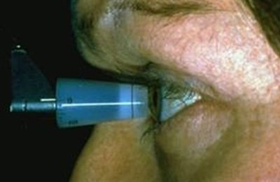 Glaucoma altre forme