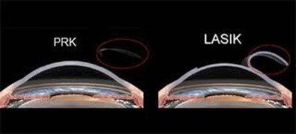 PRK VS LASIK