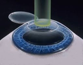Lasik