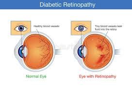 Retinopatia Diabetica: Cura e Cause