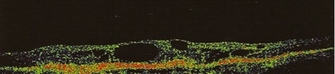 Retinopatia Diabetica