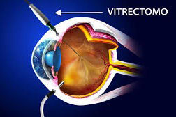 Retinopatia Diabetica