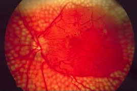 Retinopatia Diabetica