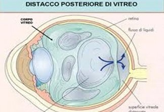 Degenerazione del Vitreo