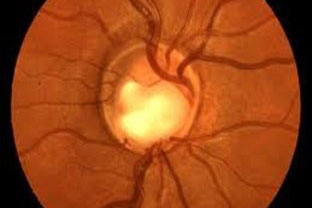 Eyetronic (Glaucoma)