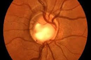 Glaucoma: Cos'è?