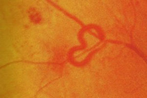 Retinopatia Diabetica: Cura e Cause
