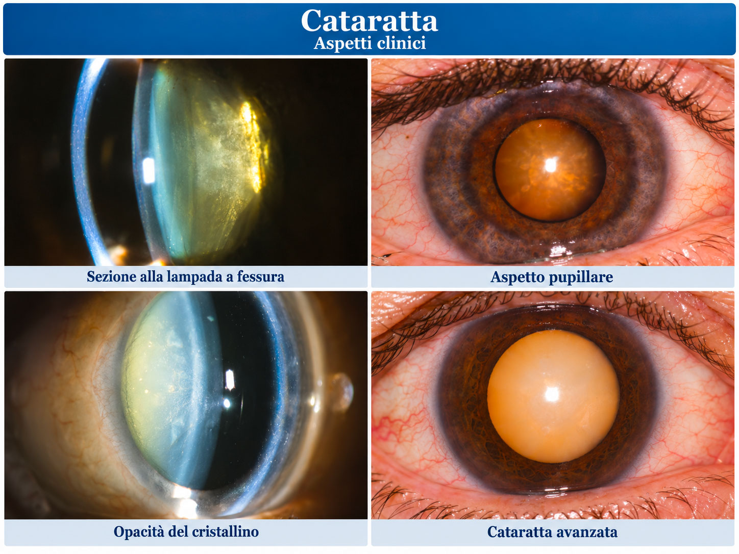 Illustrazione sugli aspetti clinici della Cataratta