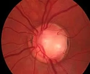 Glaucoma