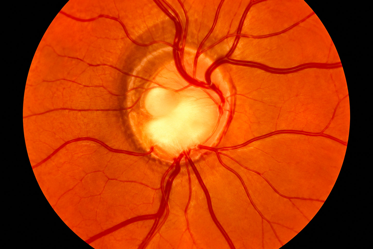 Glaucoma