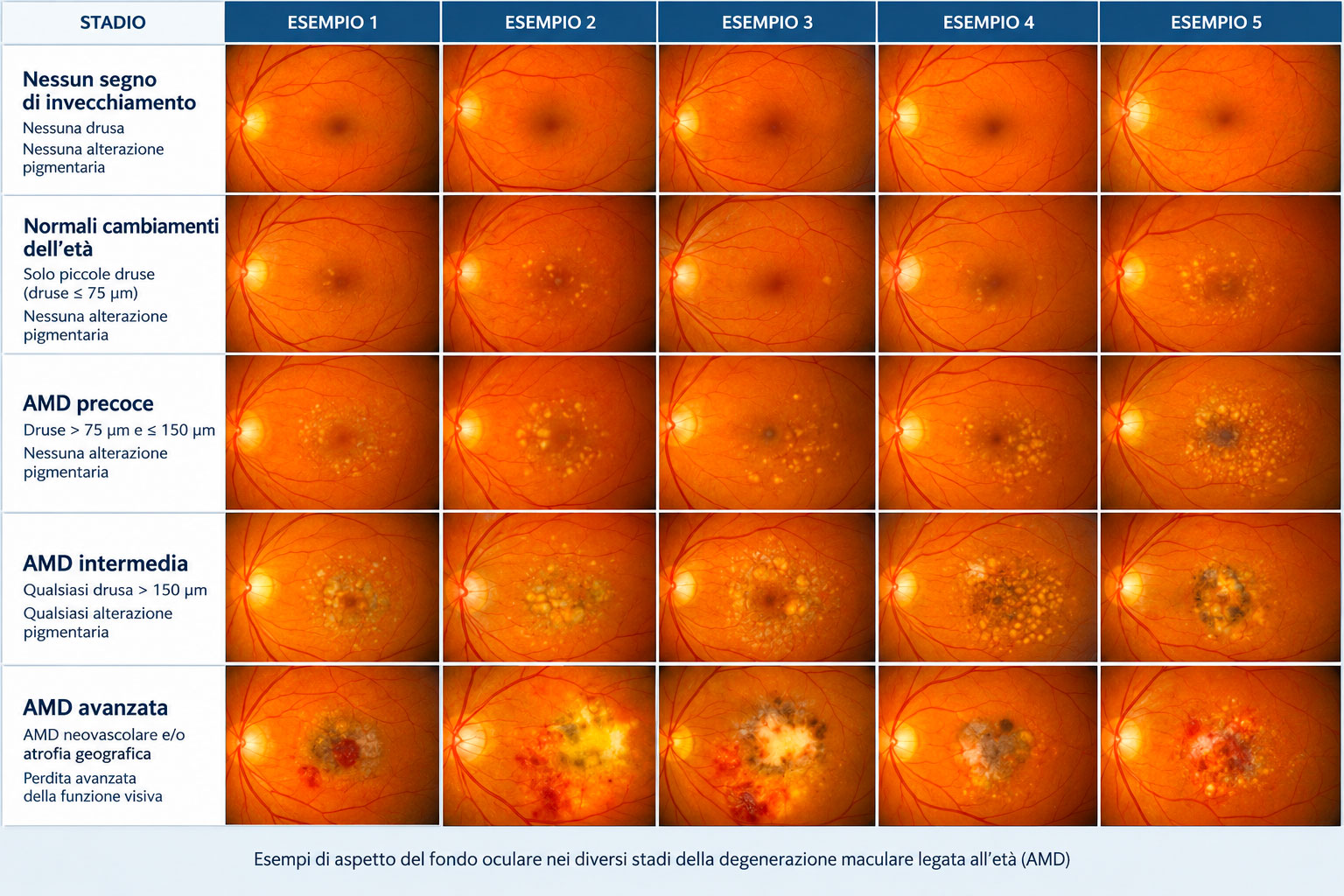 Illustrazione che mostra esempi di aspetto del fondo oculare nei diversi stadi della degenerazione maculare legata all'età