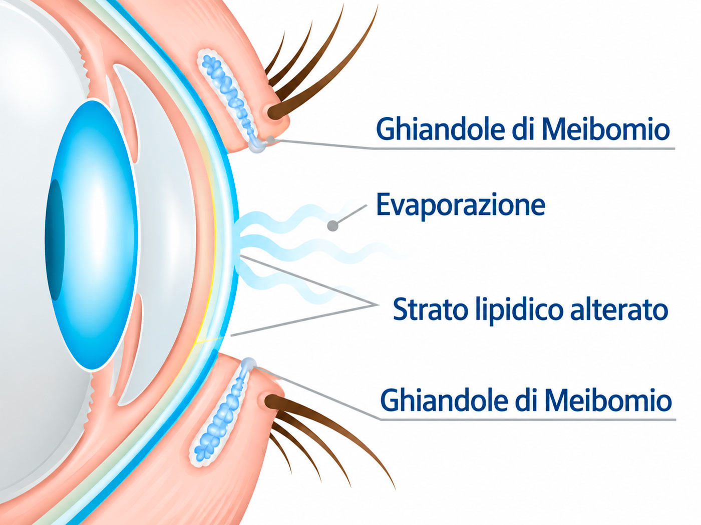 Illustrazione Occhio Secco
