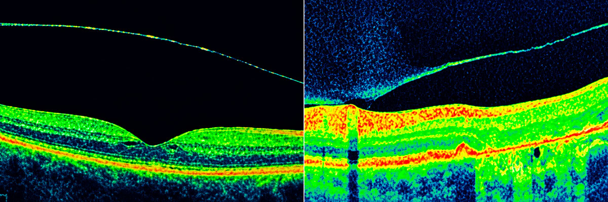 Diagnosi degenerazione del vitreo