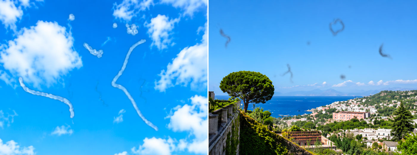 Immagine che mostra la degenerazione del vitreo